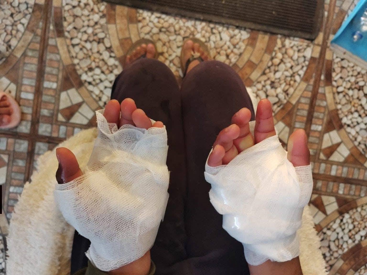 Niña de 11 años con quemaduras es atendida en el hospital Honorio Delgado Espinoza (Foto: Difusión)