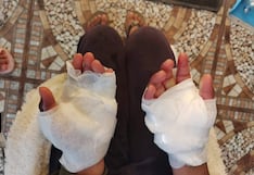 Niña quemada por su padre en Puno es atendida en el hospital Honorio Delgado, Arequipa