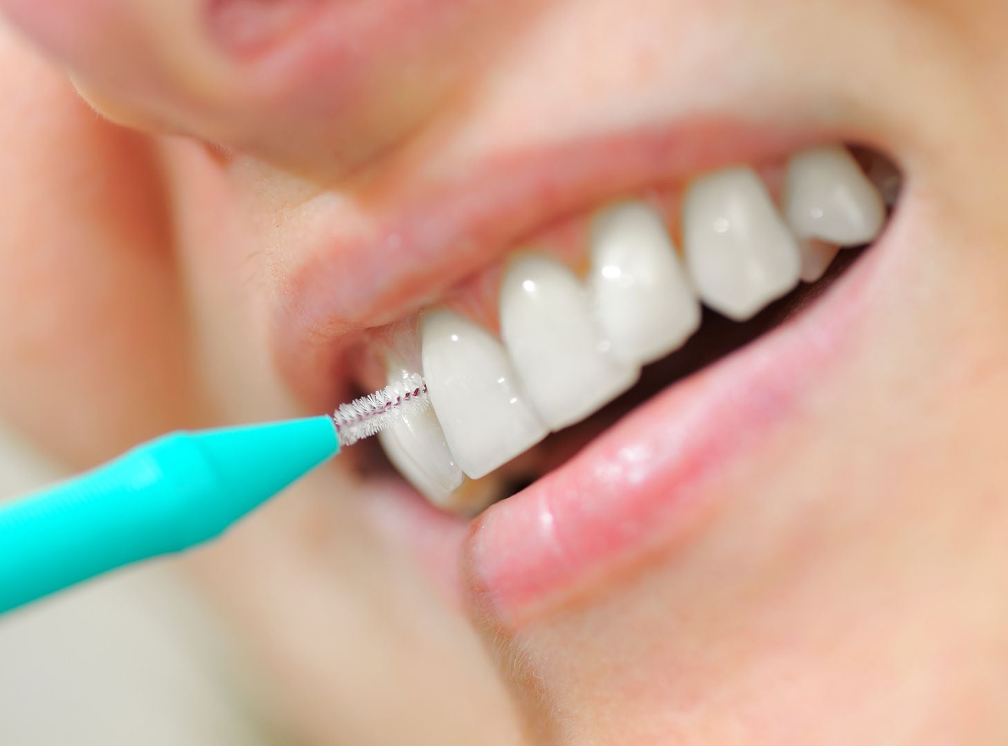 La limpieza entre los dientes sigue siendo una práctica poco frecuente, pese a que ayuda a prevenir la acumulación de placa bacteriana y reduce el riesgo de caries y enfermedades periodontales. Un especialista explica cómo utilizar correctamente los cepillos interproximales.