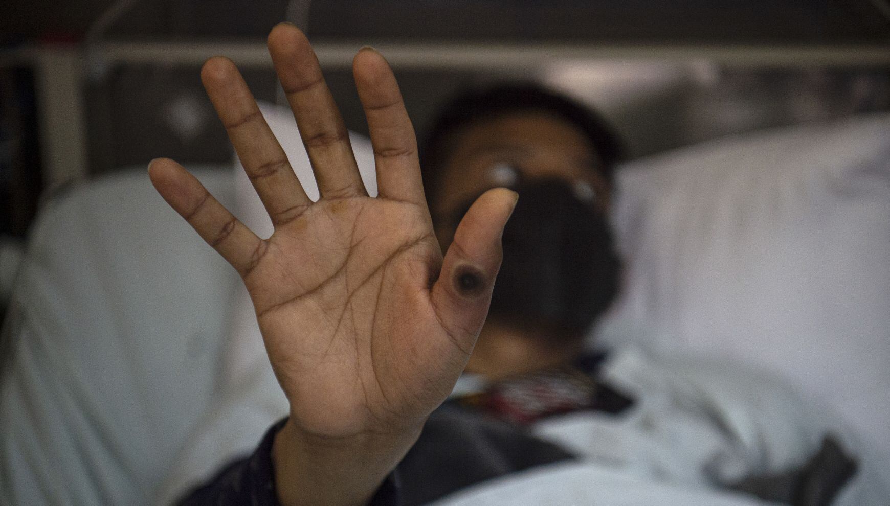 Es una enfermedad viral que se presenta con síntomas similares a los de la viruela tradicional. (Foto: Ernesto Benavides / AFP)