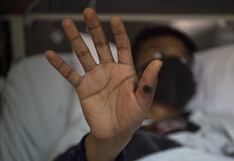 Viruela del mono: ¿Cuáles son los síntomas del mpox?