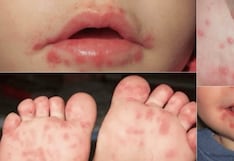 Pisco: reporte del Hospital San Juan de Dios confirma 113 casos del virus manos, pies y boca