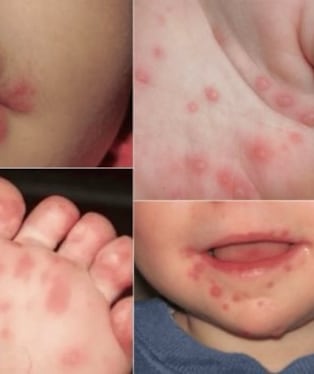 Pisco: reporte del Hospital San Juan de Dios confirma 113 casos del virus manos, pies y boca