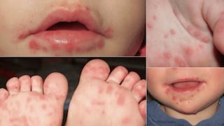 Pisco: reporte del Hospital San Juan de Dios confirma 113 casos del virus manos, pies y boca