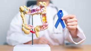 Cuatro medidas clave para reducir el riesgo de cáncer de colon, según especialistas