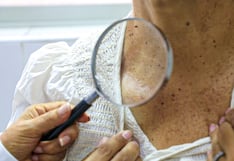 Piura: Revisar un lunar hoy puede salvar tu vida