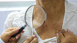 Piura: Revisar un lunar hoy puede salvar tu vida