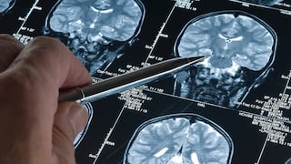¿A qué edad comienza el Alzheimer? Estudio revela cambios cerebrales desde los 50 años