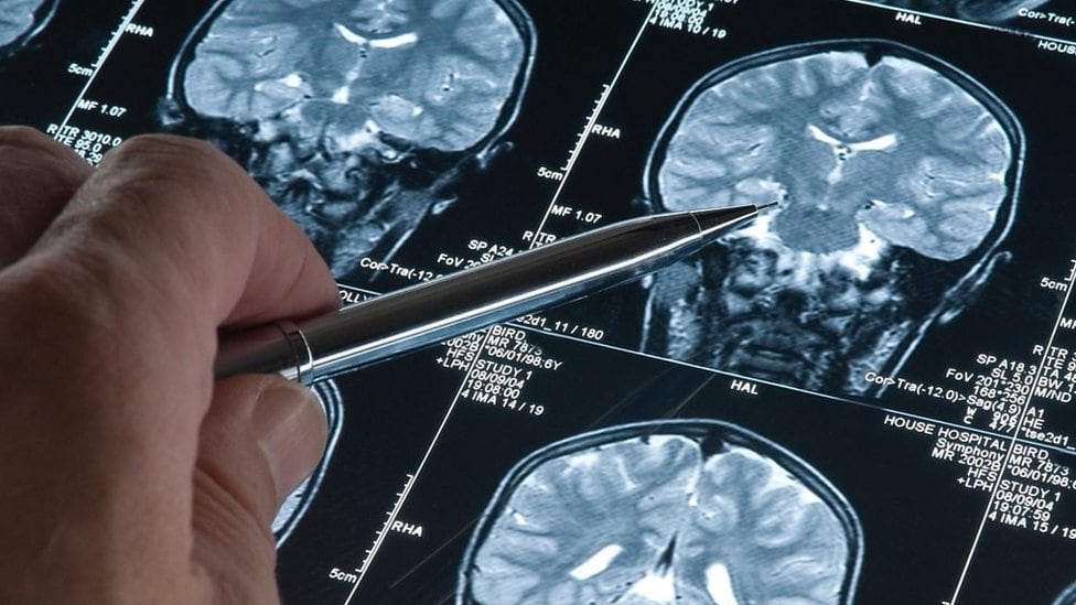 El estudio identificó periodos clave en los que biomarcadores cerebrales y sanguíneos relacionados con la enfermedad empiezan a acelerarse, abriendo nuevas posibilidades para la detección temprana y la prevención.
