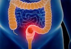 Cáncer gastrointestinal: médicos alertan aumento de casos en adultos menores de 50 años