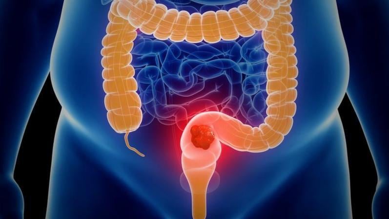 Especialistas advierten que no solo el cáncer colorrectal está creciendo en personas jóvenes. También aumentan los diagnósticos de cáncer de estómago, esófago y páncreas.