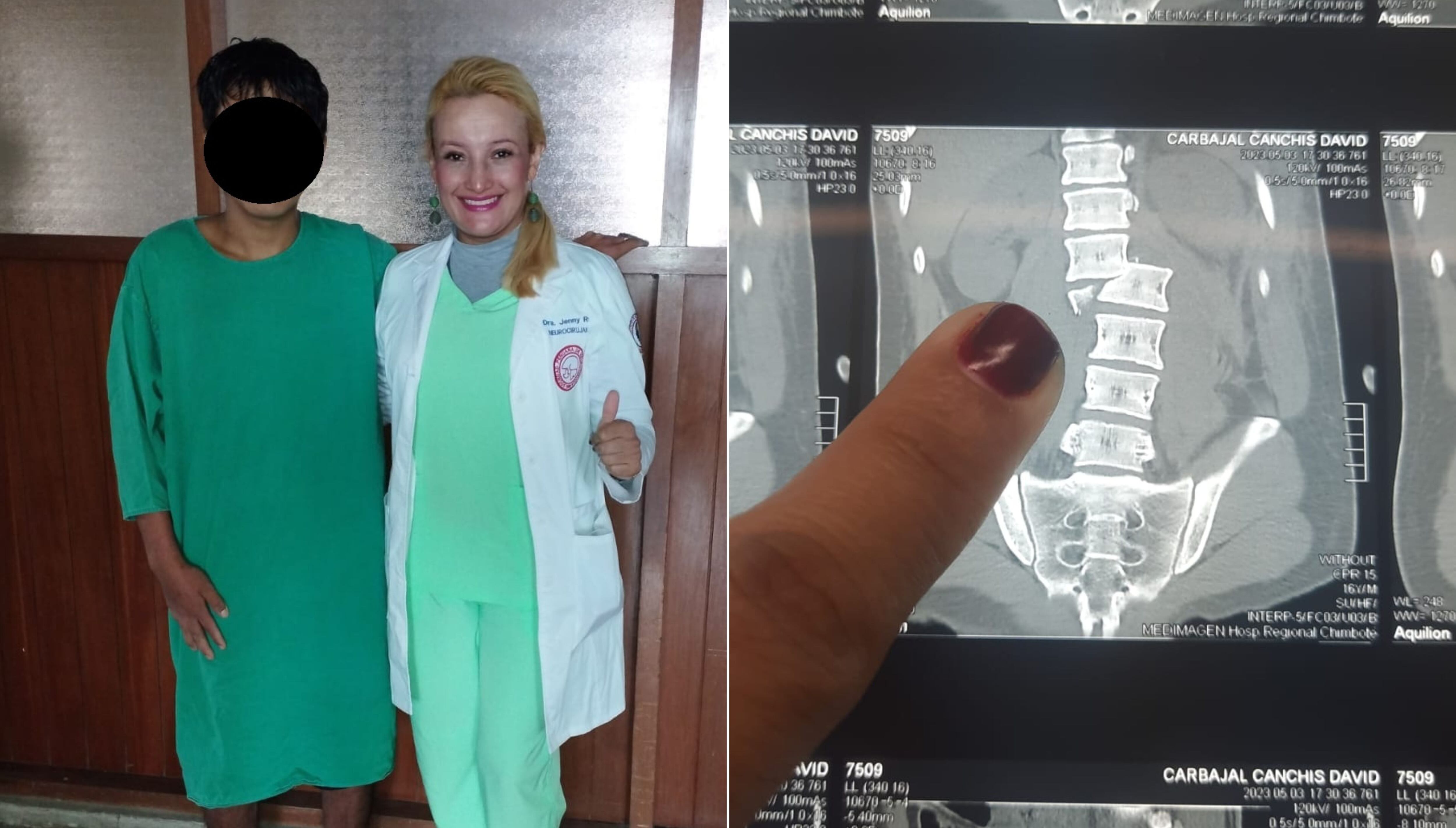 Adolescente de 16 años fue intervenido en el Hospital Regional Eleazar Guzmán Barrón luego de sufrir un accidente de tránsito.