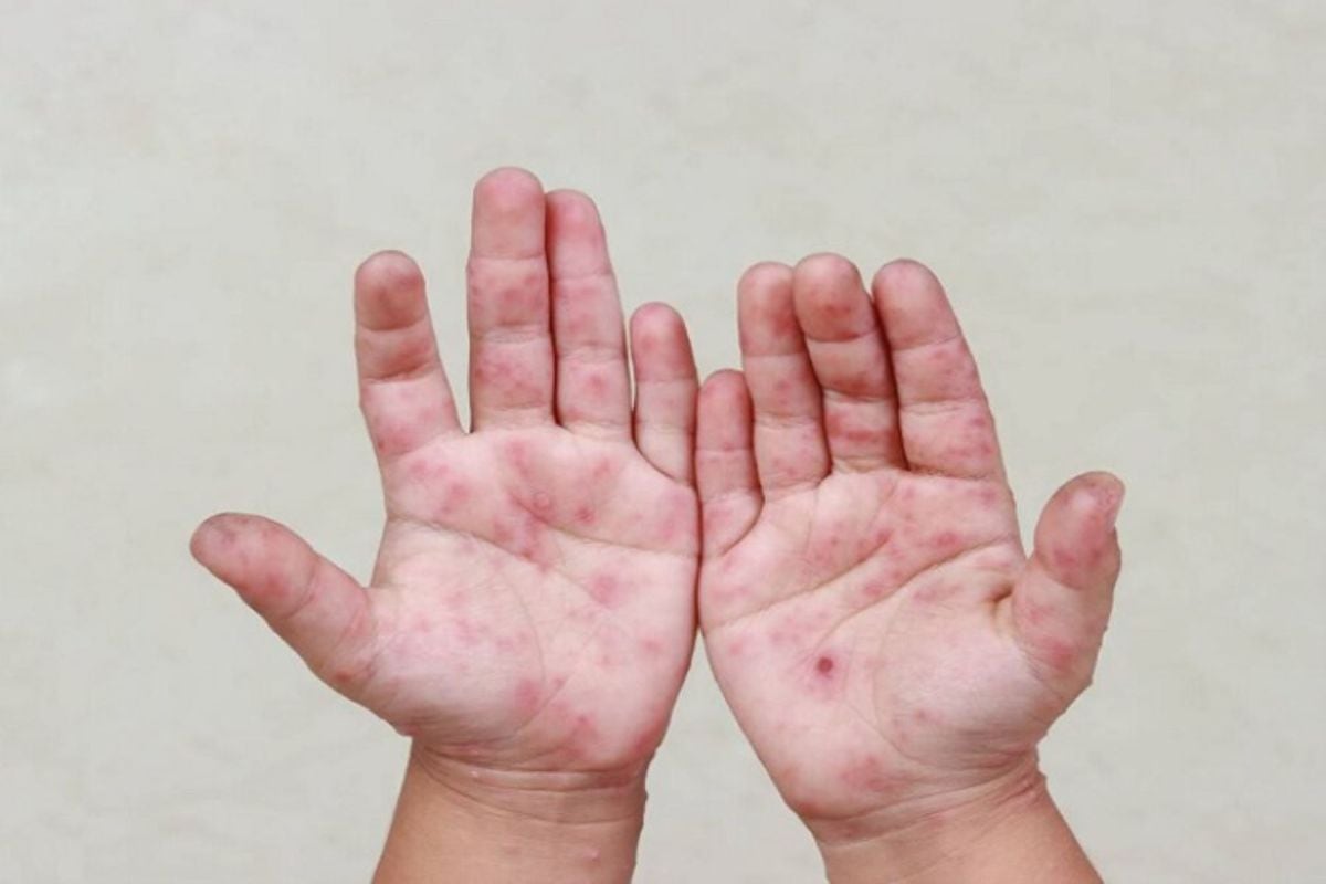 El Ministerio de Salud recomendó reforzar el aislamiento preventivo, la higiene y la ventilación en colegios tras confirmarse casos de la enfermedad de manos, pies y boca. (Foto: Andina)