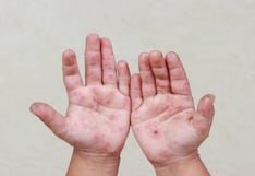 Minsa emite recomendaciones tras casos del virus Coxsackie en colegios de Lima