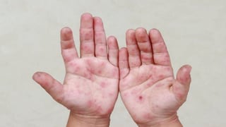 Minsa emite recomendaciones tras casos del virus Coxsackie en colegios de Lima