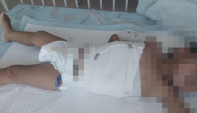 Niño de 2 años sufre quemaduras de 2do grado tras caerle agua hervida: madre pide apoyo