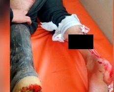 Herido de bala en la pierna