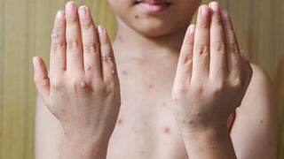 Piura: Sullana reporta 23 casos de varicela en lo que va del año