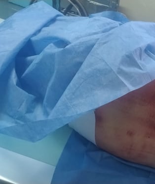 Acusado de tentativa de agresión sexual a menor se encuentra internado en hospital Carlos Seguín Escobedo de EsSalud. Foto: familia golpeado.