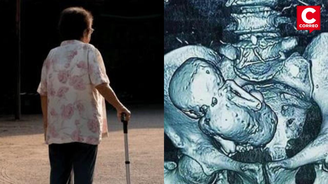 Encuentra 'feto calcificado' en mujer de 81 años