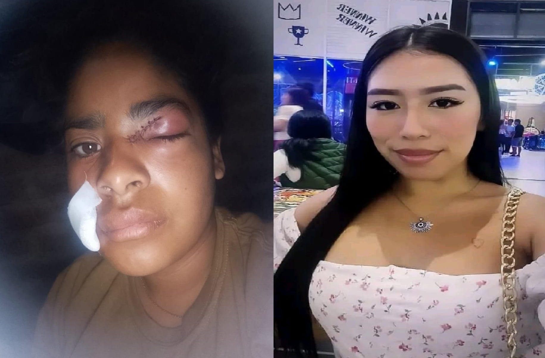 Comerciante informal no puede trabajar debido a que su rostro aún está hinchado y con puntos. Otra comerciante (mujer de lado derecho) la atacó con un arma punzocortante.