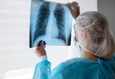 Cáncer de pulmón: estudio reporta que más de la mitad de pacientes siguieron sin progresión tras siete años