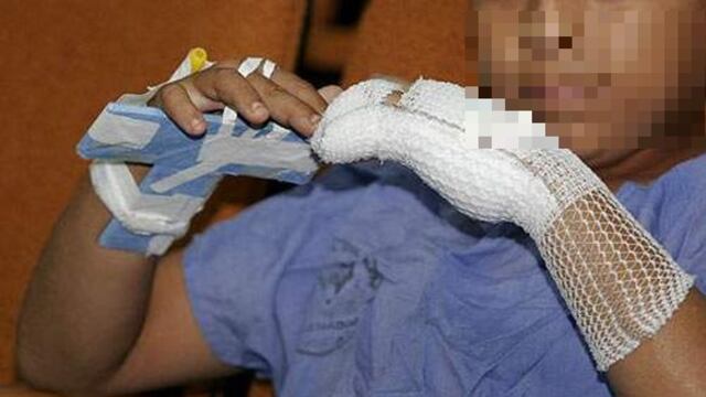 La Libertad: Un adolescente pierde parte del dedo por manipular pirotécnicos