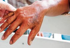 Dirección Regional de Salud detecta primer caso de lepra en Piura