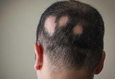 Alopecia Areata: cuándo la caída del cabello puede ser una enfermedad autoinmune