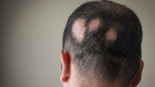 Alopecia Areata: cuándo la caída del cabello puede ser una enfermedad autoinmune
