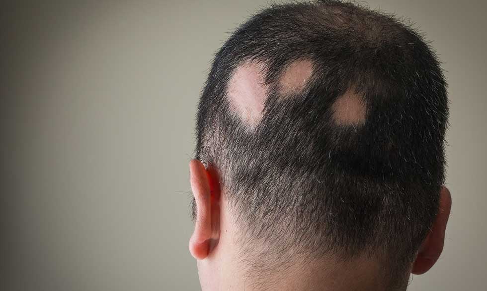 La Alopecia Areata puede aparecer de forma repentina y afectar no solo el cuero cabelludo, sino también la autoestima y salud mental de quienes la padecen.