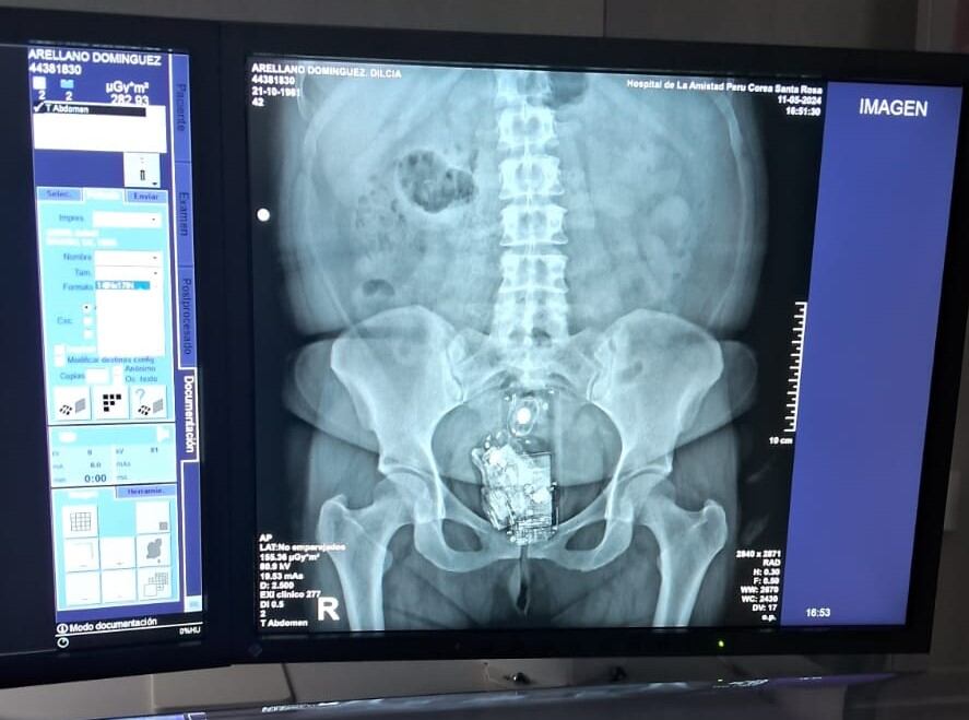 Ecografía reveló que mujeres pretendía ingresar objetos prohibidos a penal de Piura entre sus partes íntimas