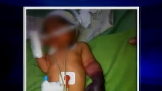 Mano de recién nacida será amputada por negligencia médica 
