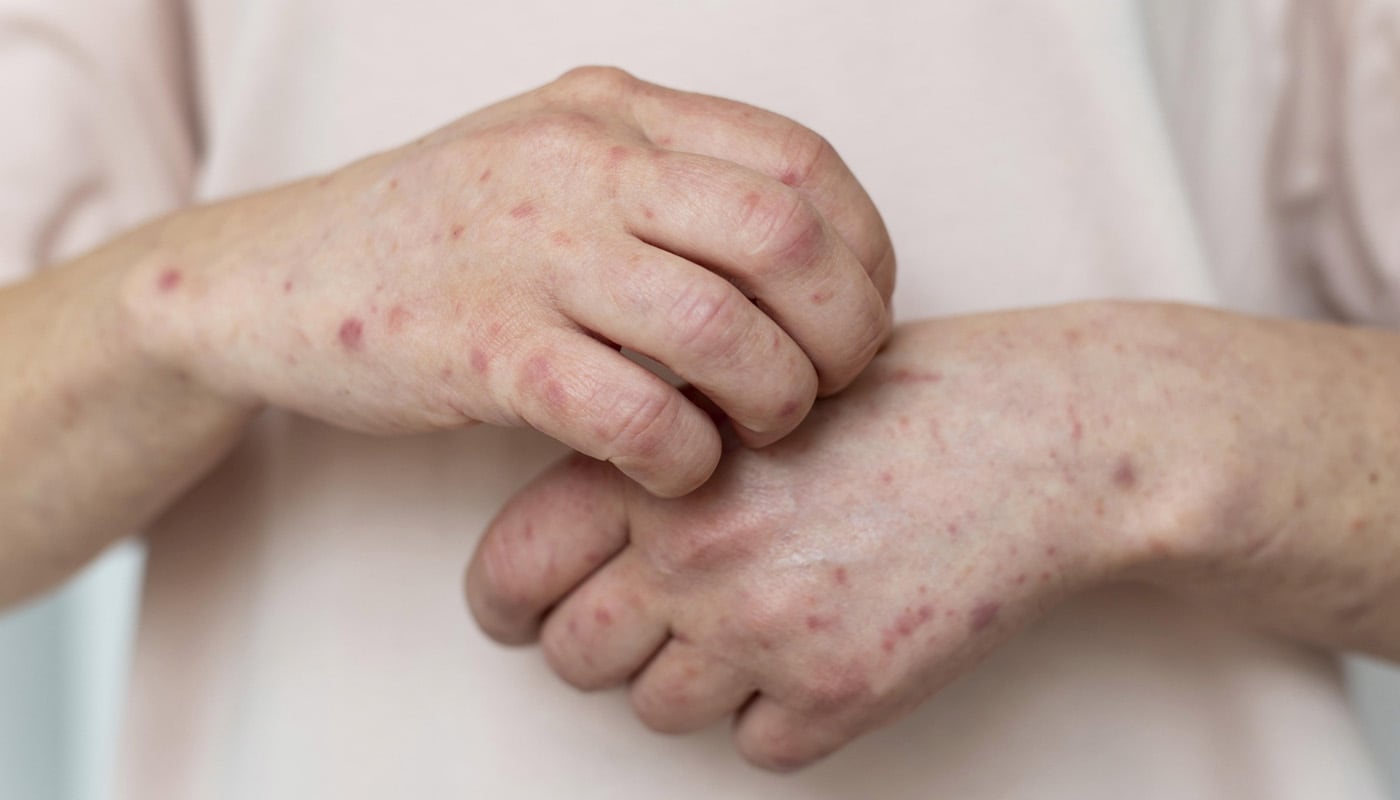 4 días después de los síntomas iniciales, suele aparecer el característico sarpullido del sarampión. | Foto: Freepik