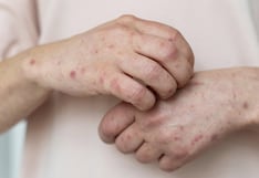 Activan alerta sanitaria en Junín por avance del sarampión en el sur del país