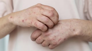 Activan alerta sanitaria en Junín por avance del sarampión en el sur del país