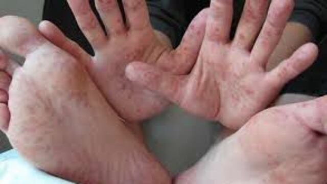 Junín: Unos 172 niños se contagian del virus de pies, manos y boca y colegios son enviados a cuarentena