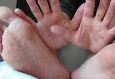 Huancavelica: Por 115 casos de Coxsackie suspenden clases presenciales en Tayacaja