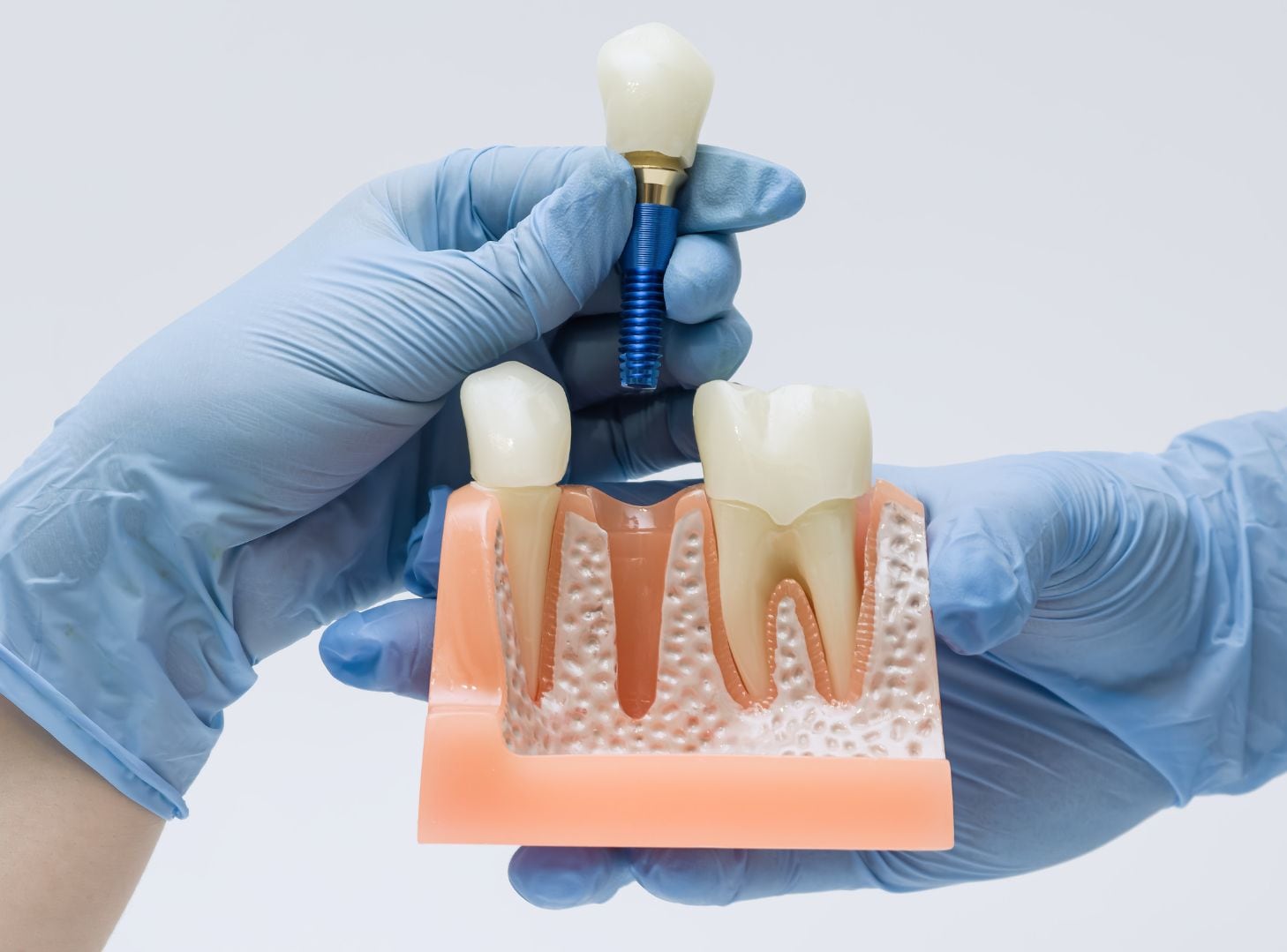 Expertos resaltan la importancia de adaptar la higiene interdental a cada paciente para preservar la salud de los implantes dentales.
