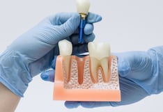 Implantes dentales: cómo cuidarlos para prolongar su vida útil y prevenir complicaciones