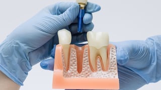 Implantes dentales: cómo cuidarlos para prolongar su vida útil y prevenir complicaciones