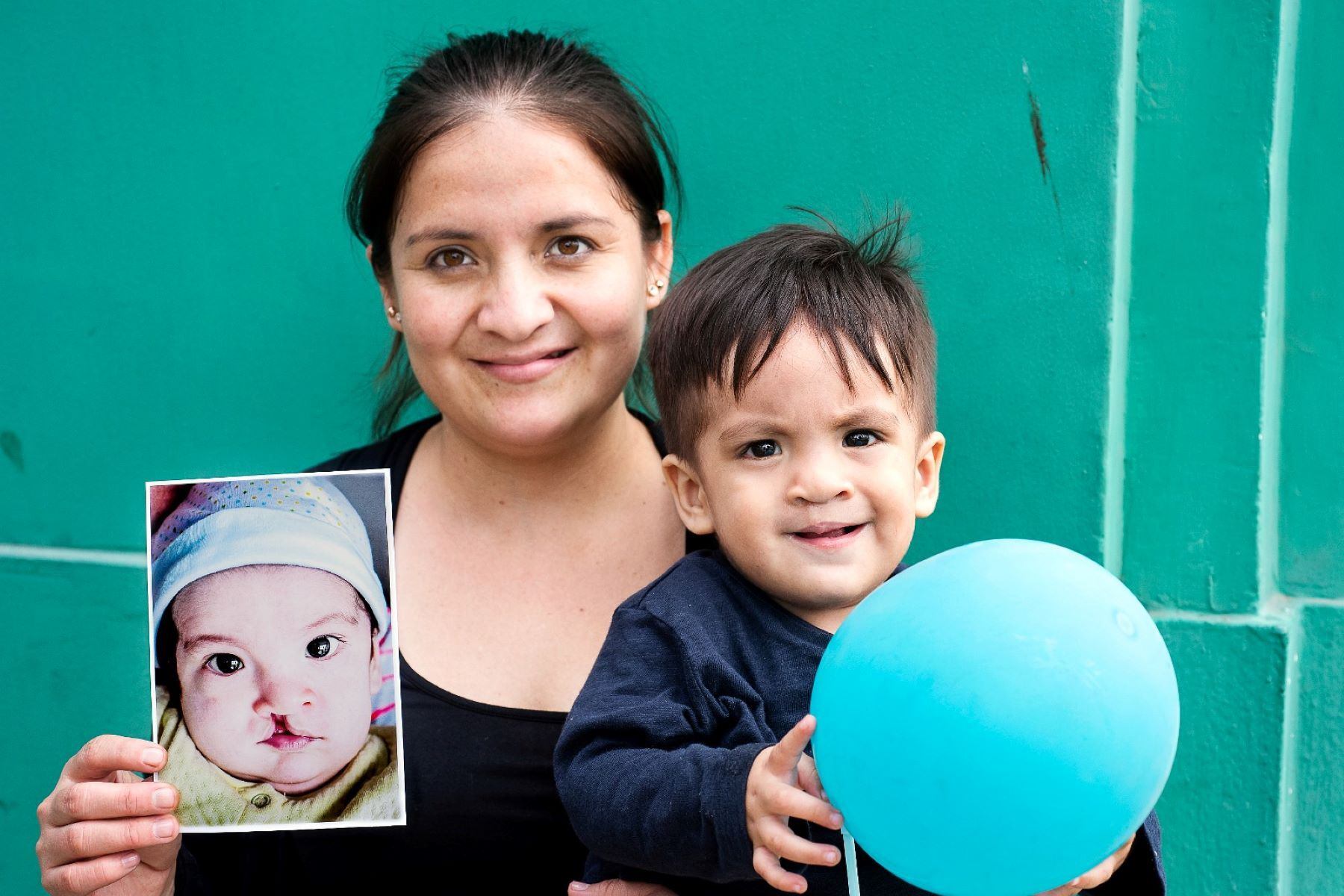 Cada tres minutos nace un niño con fisura labial o paladar hendido en el mundo. En Perú, muchos aún no acceden a tratamiento.