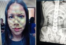 Lambayeque: Mujer ingiere 22 cápsulas con droga para pasarlas al penal