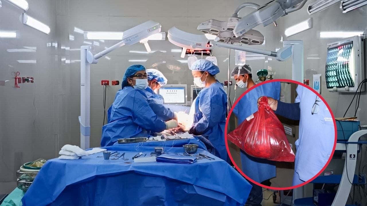 Médicos del hospital Goyeneche extirpan tumor de gran tamaño