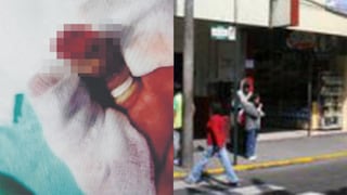 Tacna: Sereno pierde parte del dedo anular tras ataque de perro callejero