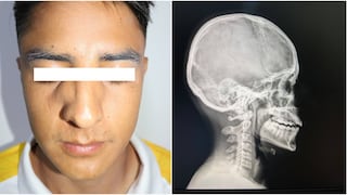 Copa Perú en Nasca: Futbolista sufrió fractura de nariz y fue trasladado en ambulancia