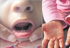 Coxsackievirus: suben a 420 los contagios en menores de cinco años en Lambayeque