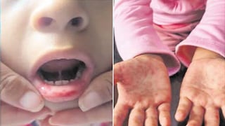 Coxsackievirus: suben a 420 los contagios en menores de cinco años en Lambayeque