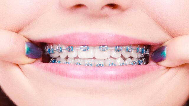 Brackets: ¿Por qué se mueven los dientes después de haberlos usado?