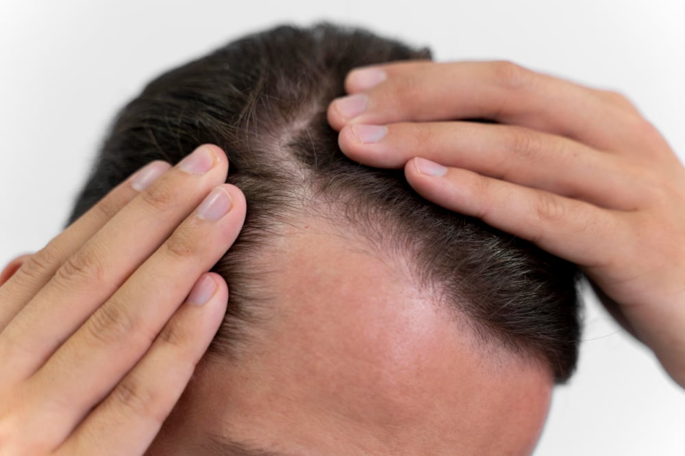 La pérdida progresiva del cabello puede comenzar años antes de que sea evidente. Expertos en tricología advierten que actuar en etapas tempranas permite preservar y fortalecer la densidad capilar.